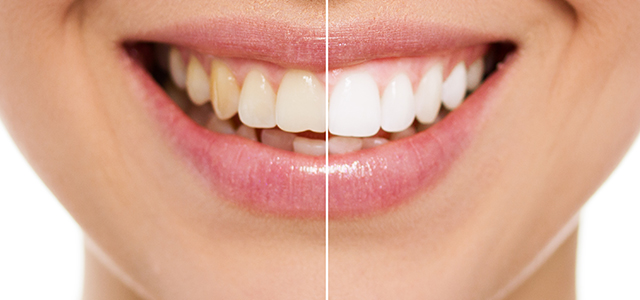 How to whiten teeth