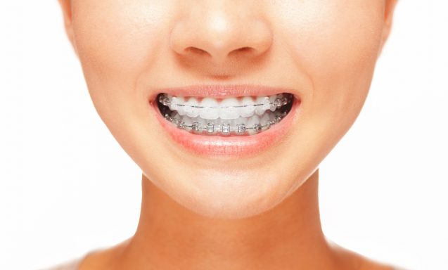 Brace Yourself For Better Oral Health