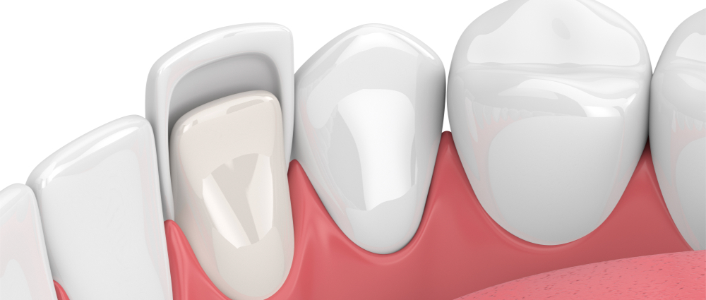 Foods You Can Eat With Dental Veneers