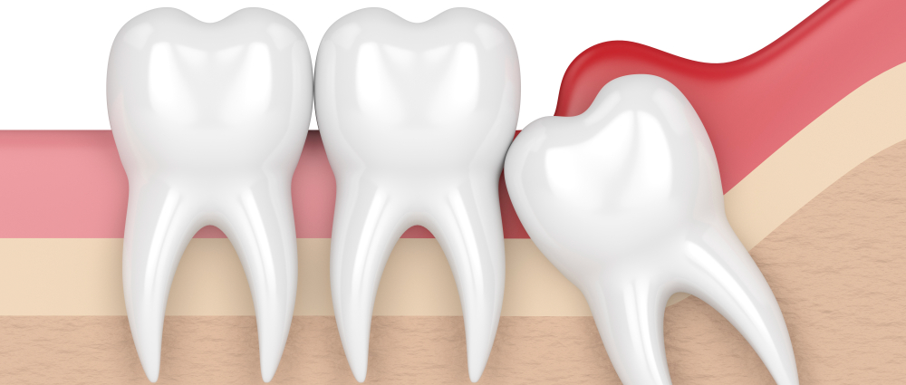 How to Cope with Pericoronitis