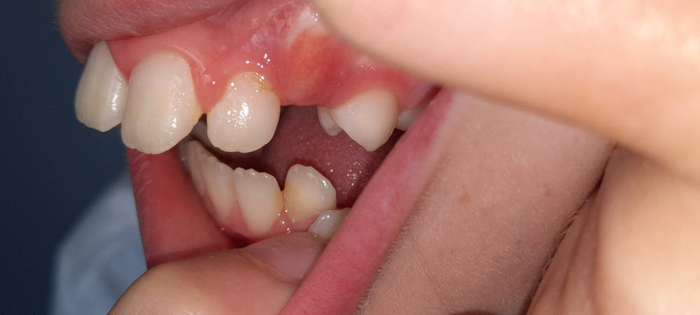 bad overbite teeth