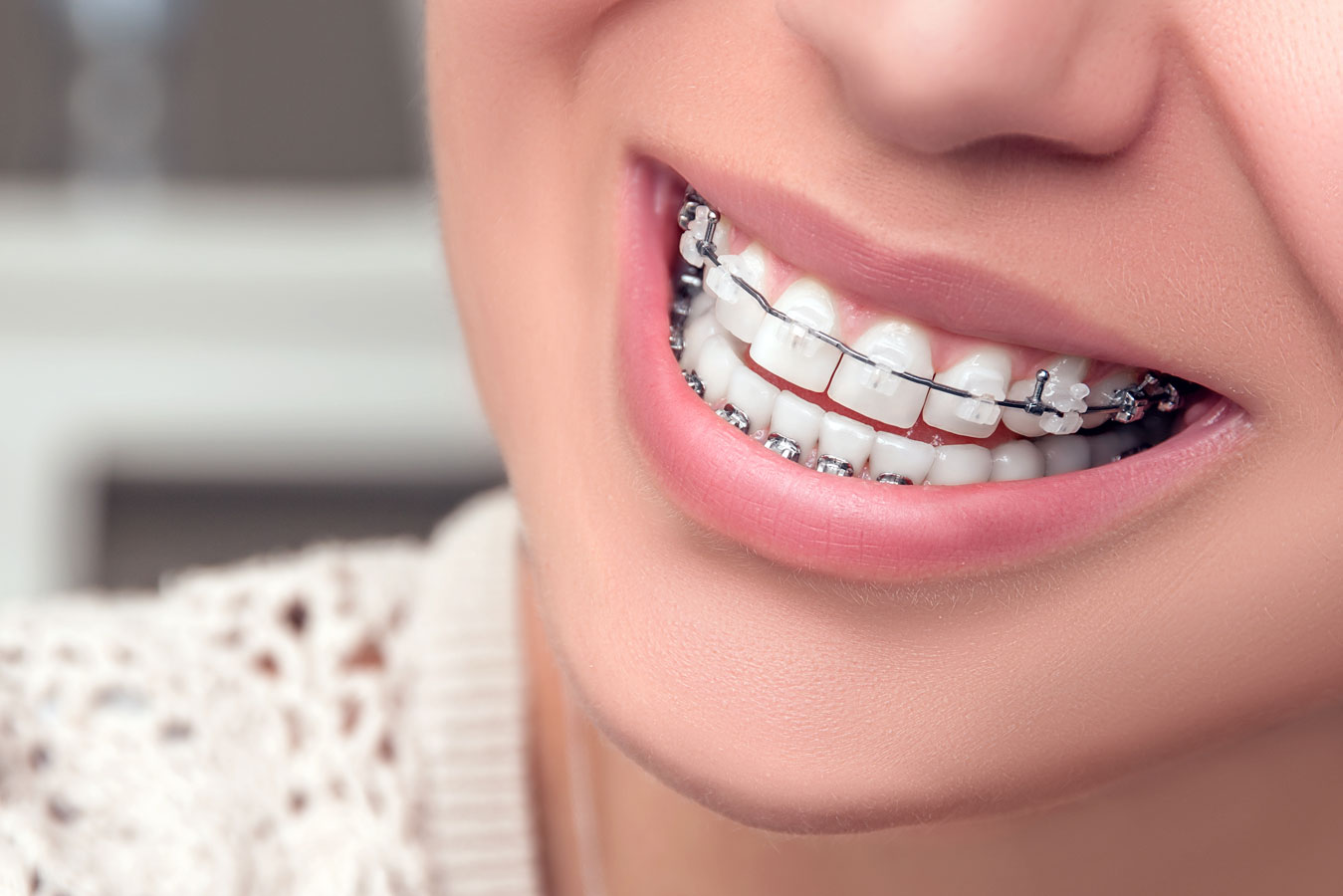 Lingual Braces — Clear Braces Sydney