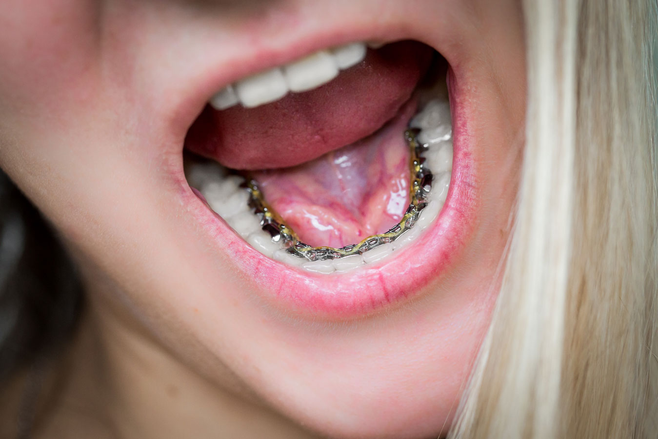 Lingual Braces –