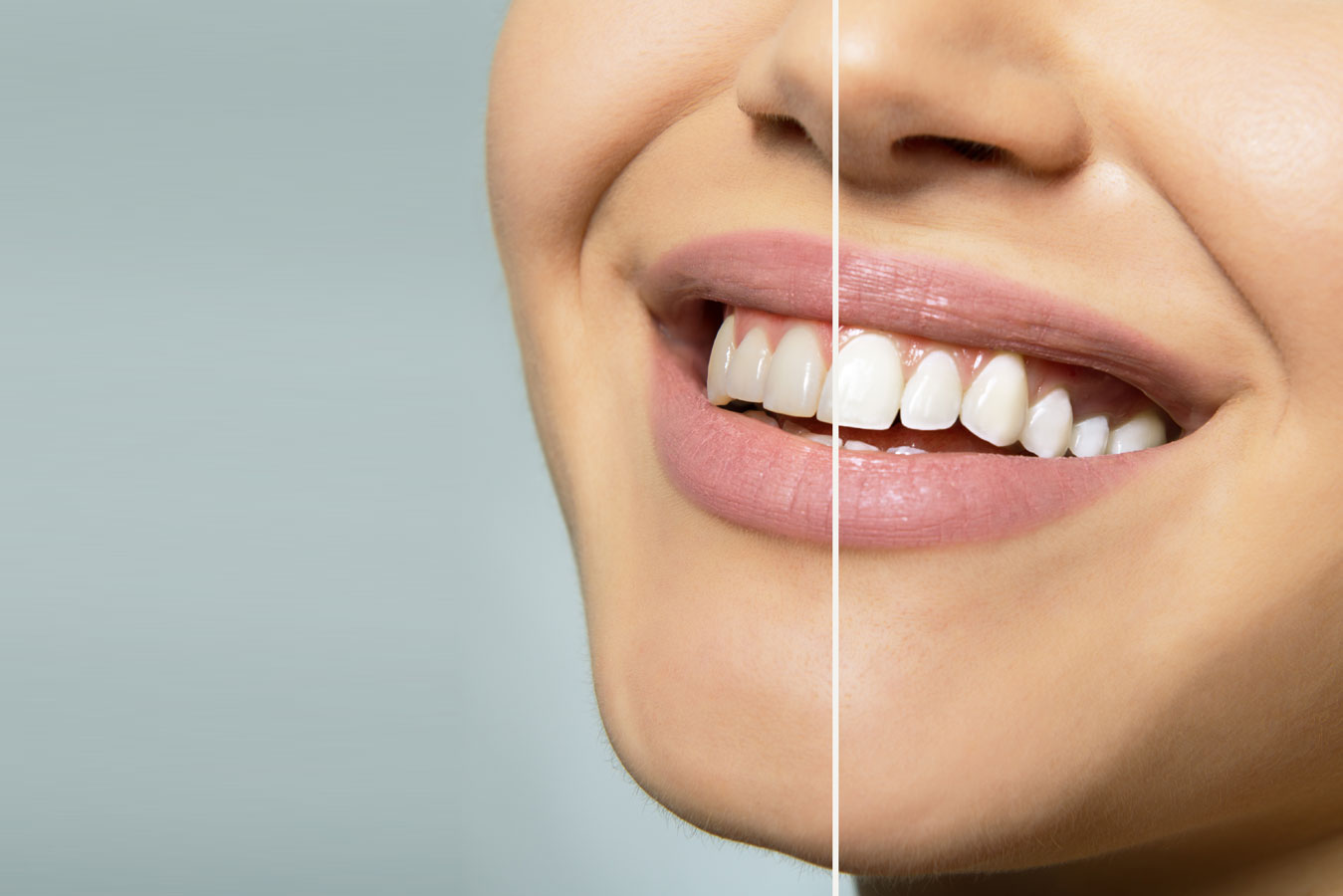 Clear Ceramic Braces Wahroonga  Wahroonga Family Dental Centre